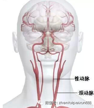 堵塞脑血管引起脑梗的血栓主要有两大来源:第一个来源,脑血管自身产生