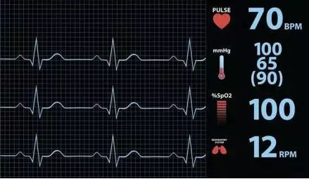 心率变化曲线图图片