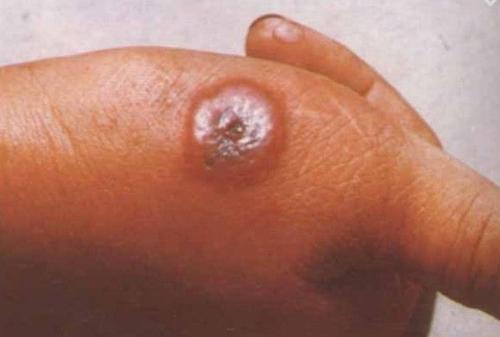 人感染炭疽病早期图片图片