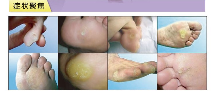 康纳角皮清正品祛除手足脚部鸡眼老茧角质增厚脚垫痛膏成膜抗菌剂淘宝