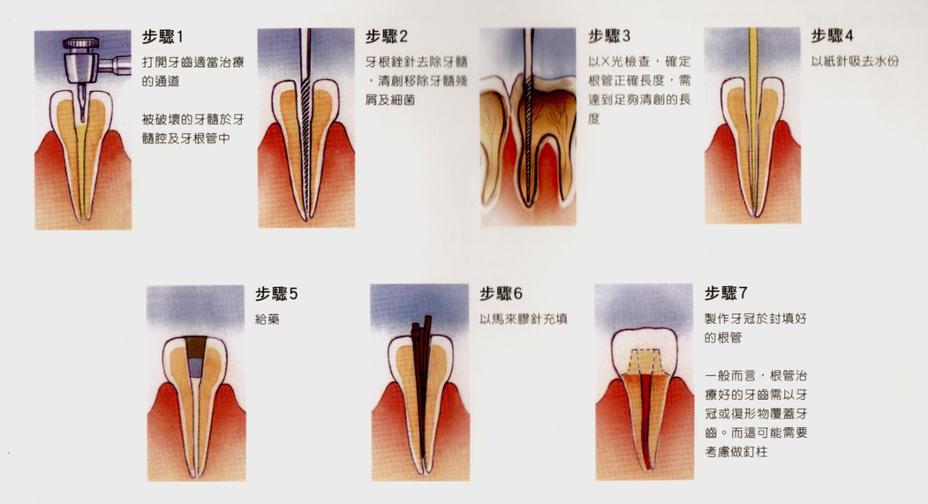 根管治療知多少——輕鬆解讀根管治療