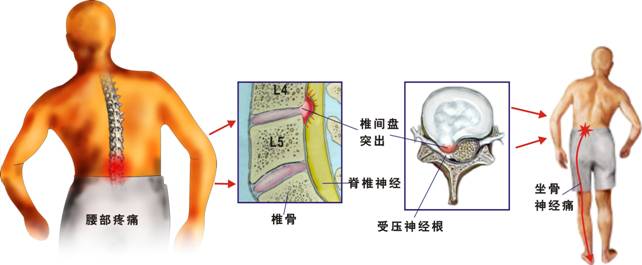 坐骨神经定位图片