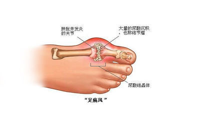 痛風患者如何飲食?