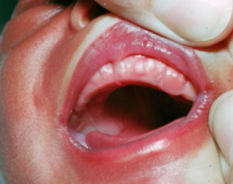 马牙或板牙:性质和粟粒疹类似,只是位于牙龈或上腭中央,大多可以自行