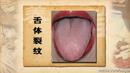 严重齿痕舌图片图片