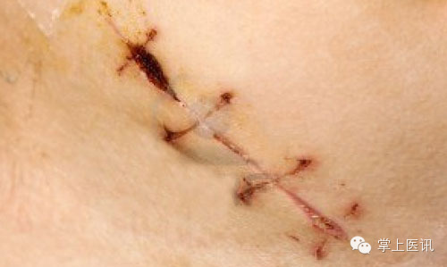 伤口缝合的秘诀
