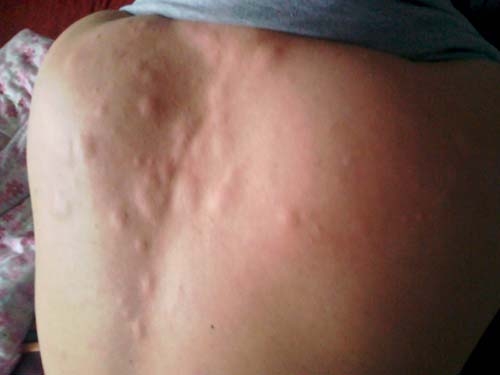 不可置信皮肤出现它竟是癌症晚期