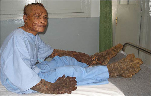 印尼树人照片手术图片