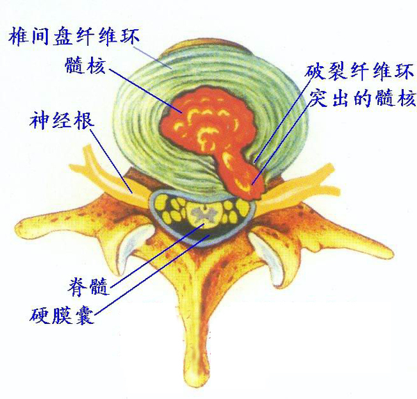 腰椎间盘突出一定要手术治疗吗?怎么治最好