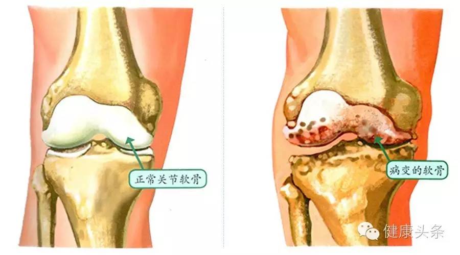 要想膝盖不疼,用到老,这份「膝盖使用手册」要收好 - 好网角收藏夹