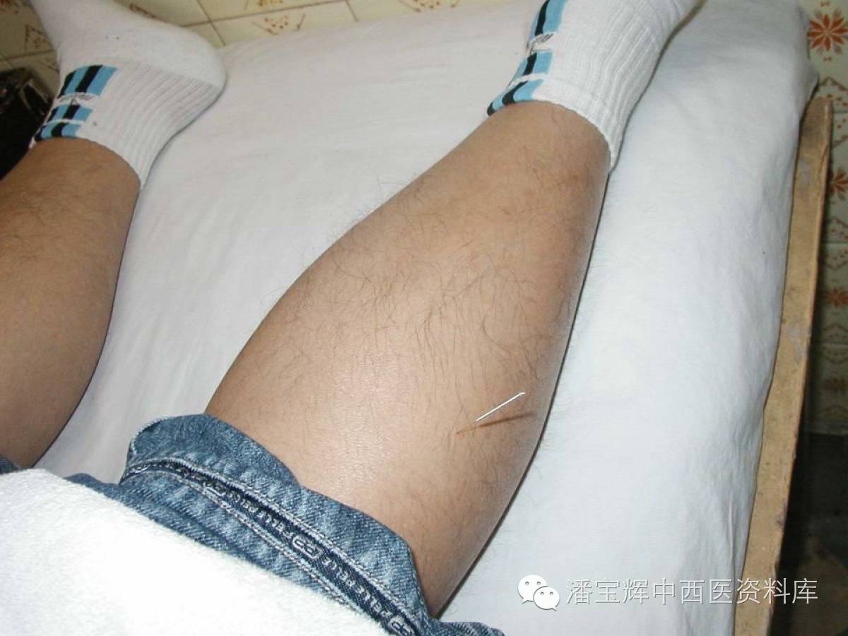 靳三针疗法 精品医学课件