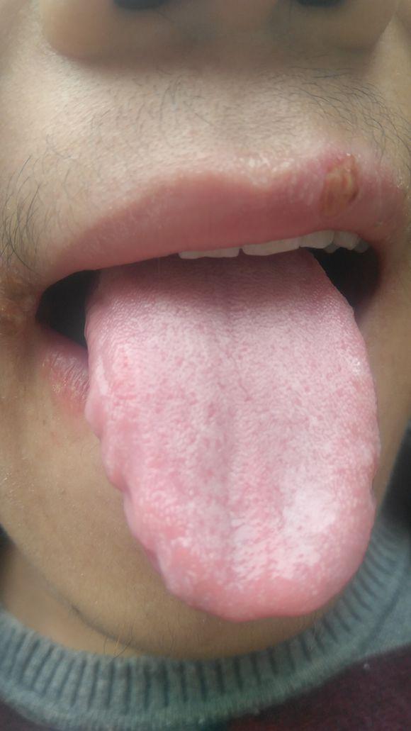 2,看你的舌像,舌体胖大边有齿痕,舌苔薄白说明体内脾虚有湿,气血不足