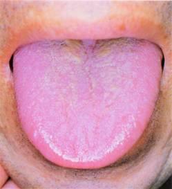 望老嫩,胖瘦,胀瘪,裂纹,芒刺,齿痕,从舌形来辨证型