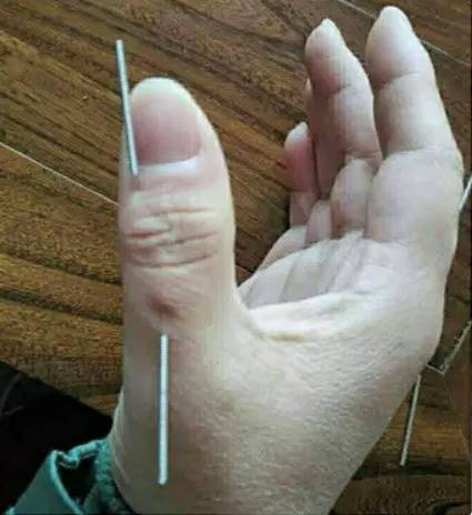 2016年11月26日    点评:此案例为经典组合针法"背三针"的典型运用