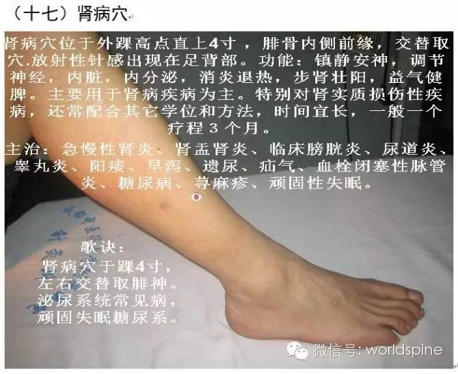 平衡针灸图解看图学针二