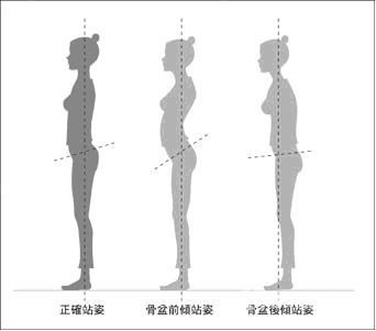 表現: 骨盆前傾最明顯的症狀是臀部後凸, 腰臀比,bmi值和體重都在正常