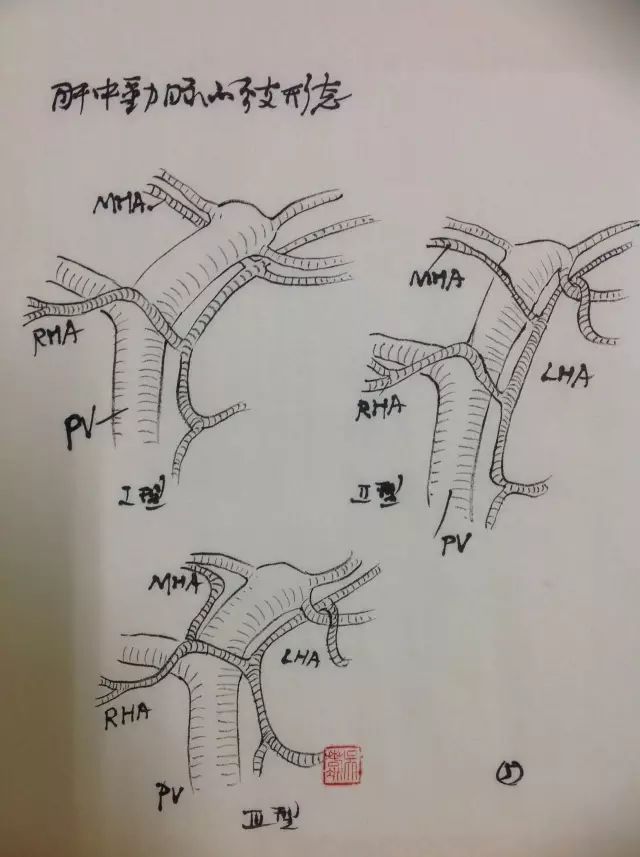 手绘图肝门部胆管癌左肝切除