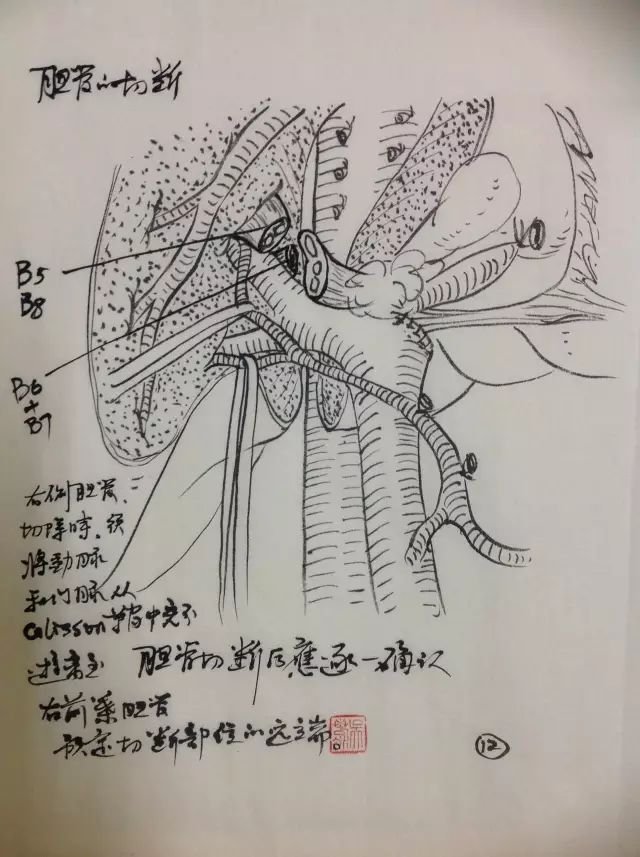 手绘图肝门部胆管癌左肝切除