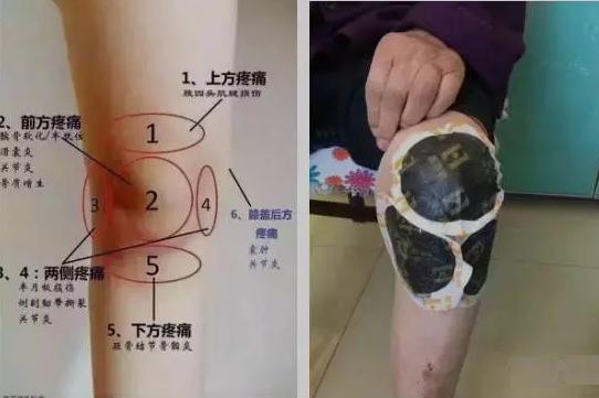 醋泡鸡蛋不用怕膝盖滑膜炎治不好用一个好一个100000加收藏