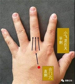 阴阳九针之针法个人经验