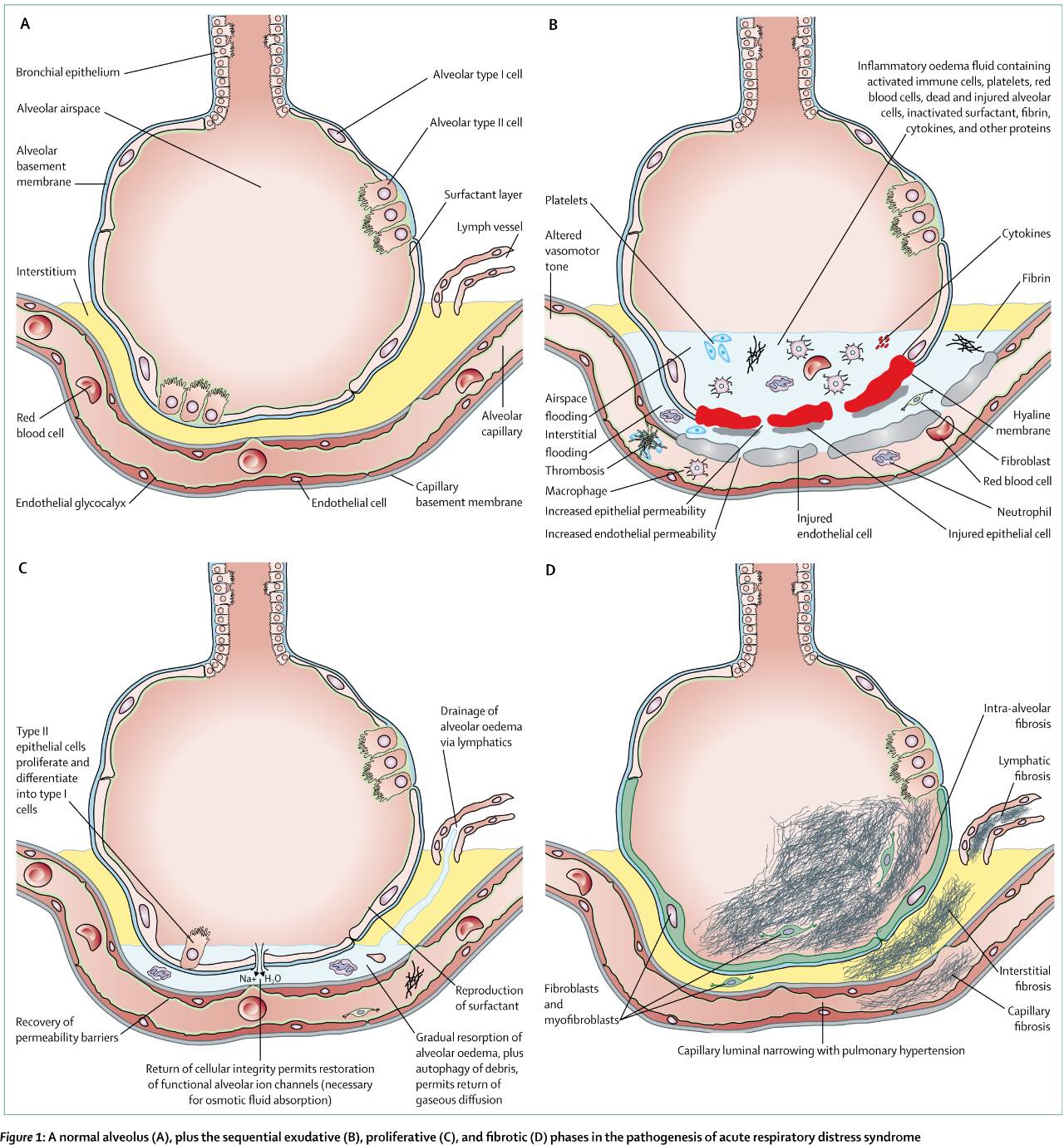 柳叶刀大综述急性呼吸窘迫综合征