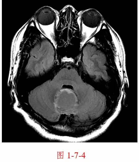 图 1-7-4 颅脑轴位 flair 图, 脑脊液信号被抑制,肿瘤周围水肿仍为高