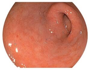 慢性萎缩性胃炎胃镜图图片