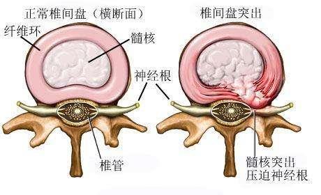 腰椎骶化图片原因图片