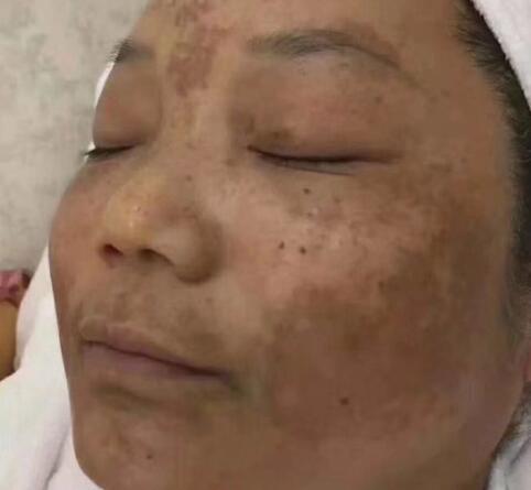 肝气郁结型黄褐斑2个处方疏肝活血排黑素祛褐斑