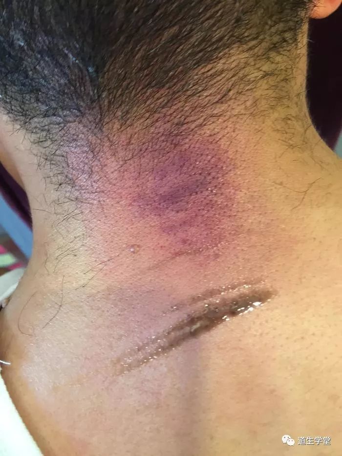 李氏砭法虎符铜砭刮痧手记之颈椎病