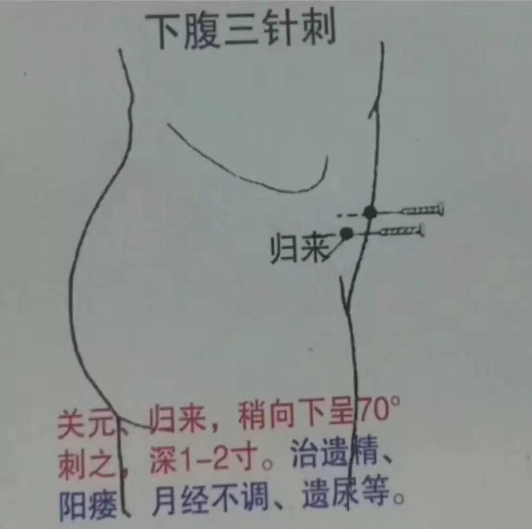 中医针灸各种刺法图文讲解