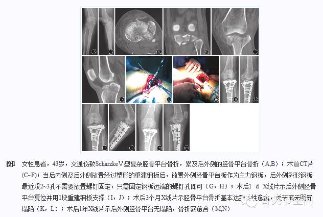 後內側聯合前外側入路復位固定治療後外側關節面塌陷的複雜脛骨平臺