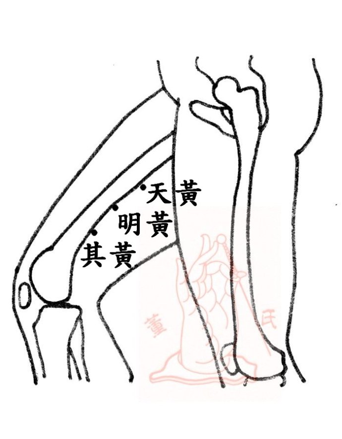 董氏针灸之眼袋的针灸治疗方法