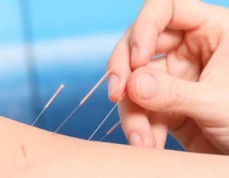 针灸运针不痛心法 初学者皆应读之!