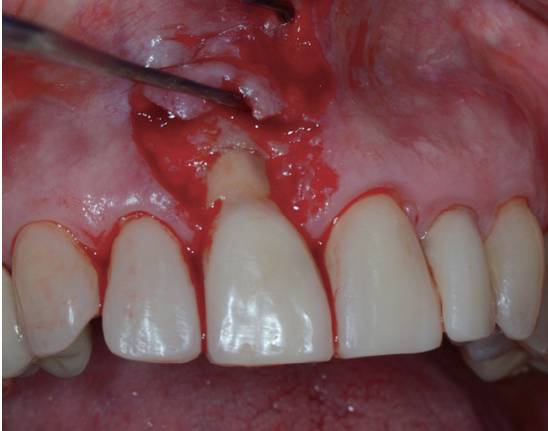 牙周软组织瓣的应用毛尔加教授