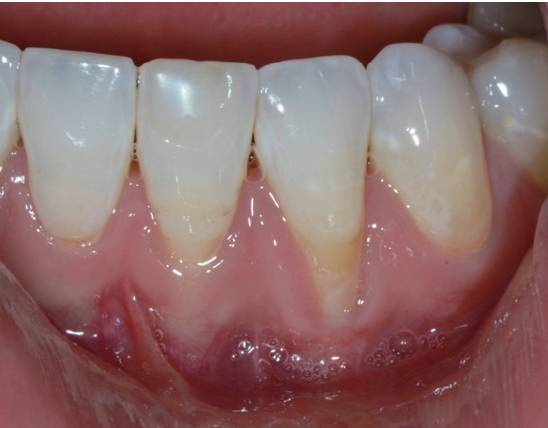 游离结缔组织瓣牙根覆盖 (图14~图16)图13   去除上皮组织图12   分离