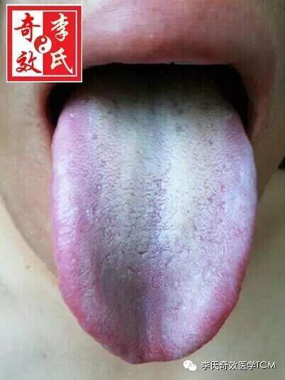 李氏奇效舌诊与望舌用药内部资料一