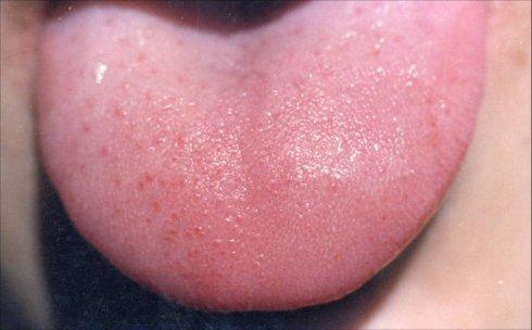 正常舌头: 淡红舌,薄白苔