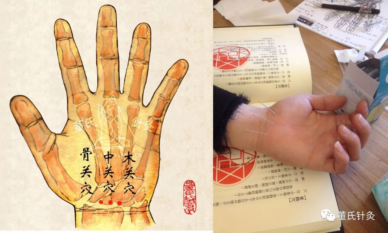 董氏针灸微课堂痛风