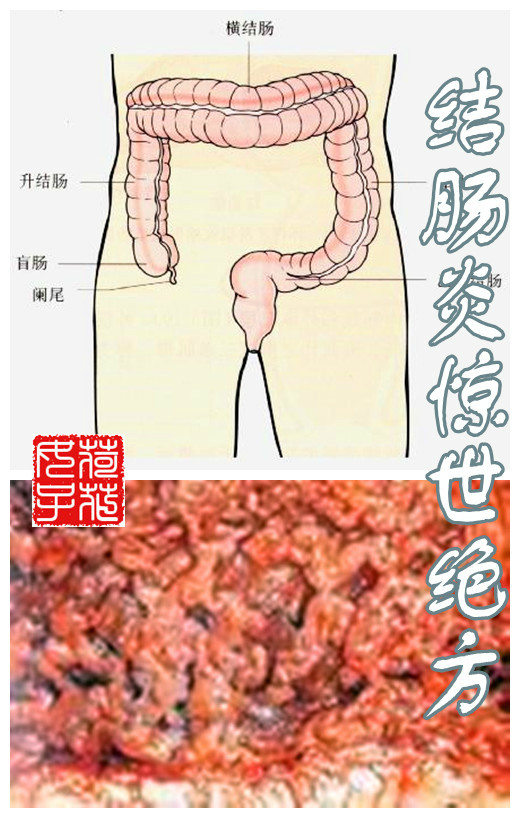 结肠炎惊世绝方