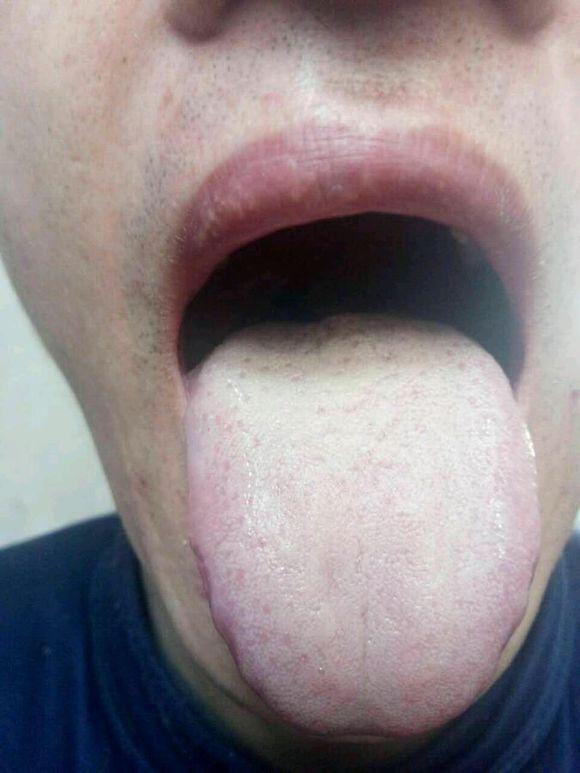 肝胆湿热舌象图片