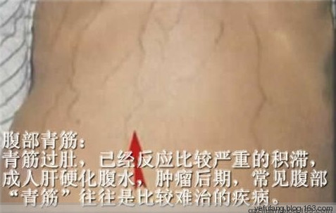 76箇中藥外敷肚臍偏方