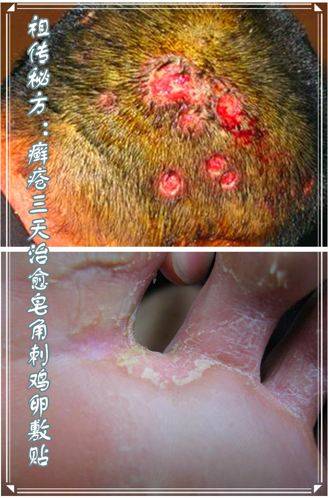 祖传秘方癣疮三天治愈皂角刺鸡卵敷贴