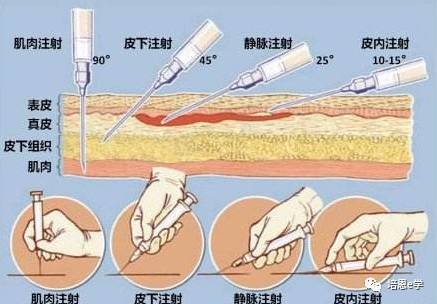 膝关节注射部位图图片