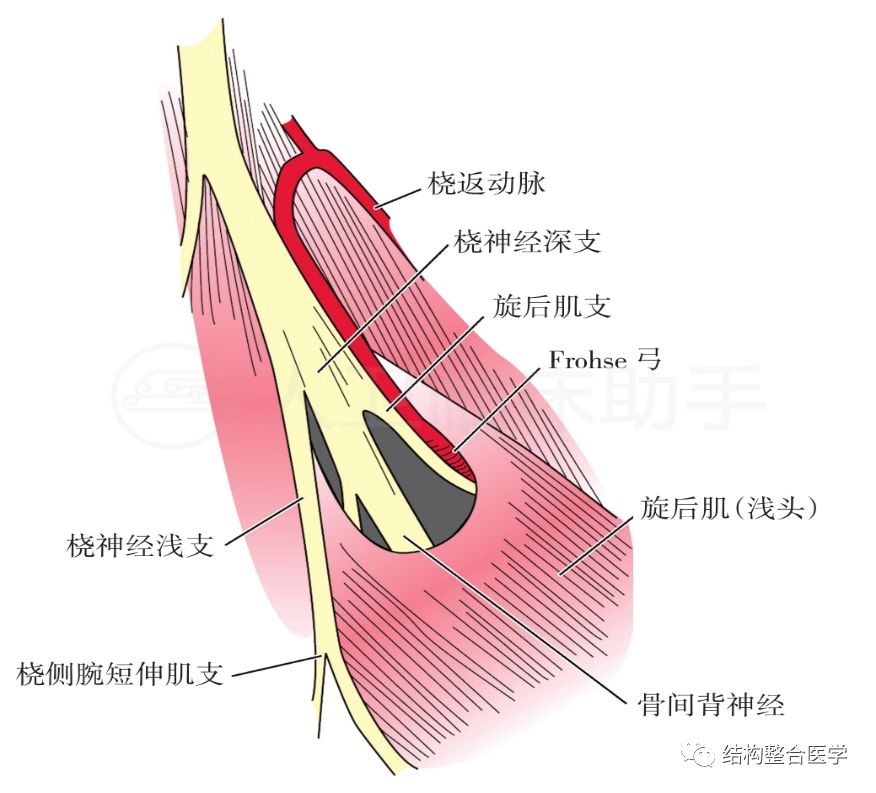 桡管综合征:对于此病有不同的说法,一般是指桡神经深支(或称骨间后