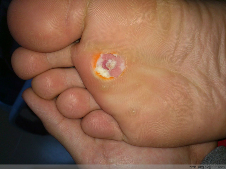 葱内膜除鸡眼 葱白热炒治扭伤