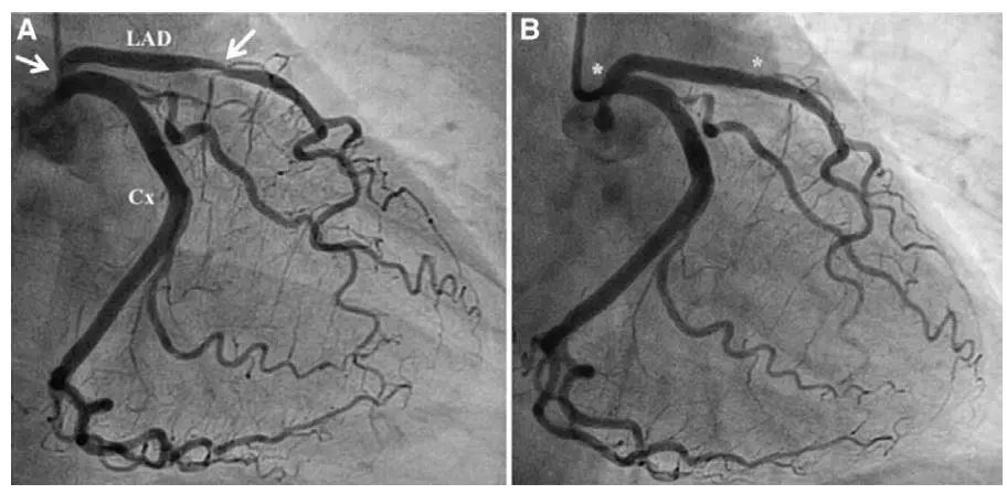 pci术后再发胸痛这种心电图变化是怎样形成的病例心编
