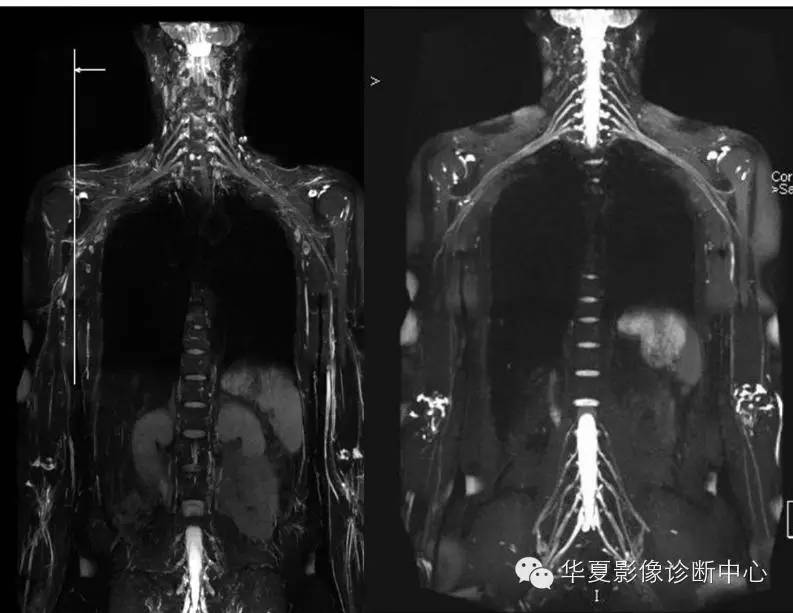 臂丛神经解剖mr成像诊断