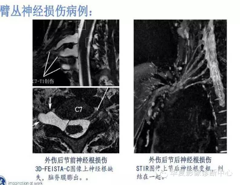 臂丛神经解剖mr成像诊断