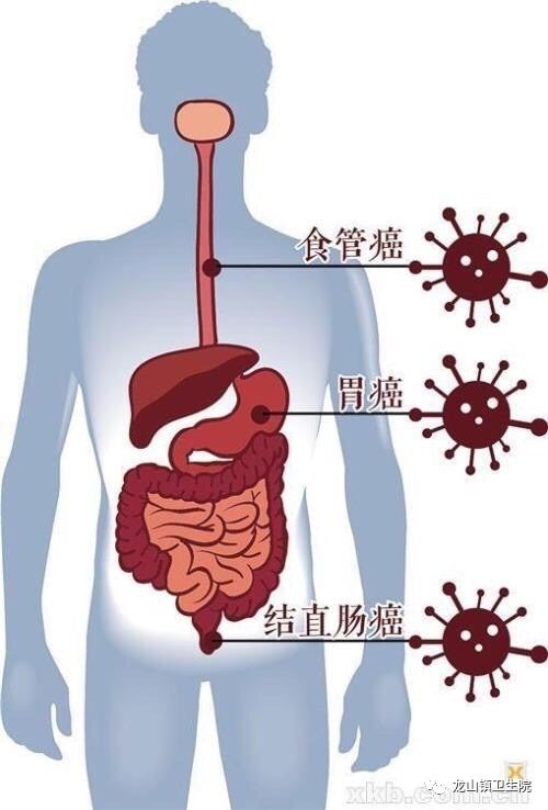 食道癌长在部位图片图片